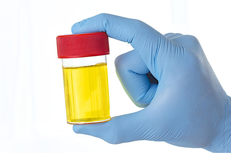 Cancro alla prostata: gli scienziati sviluppano un test delle urine a casa