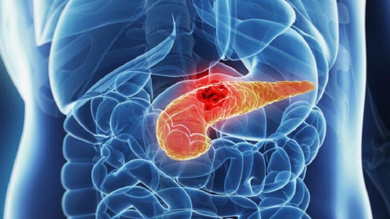 Tumore al pancreas, venerdì 17 novembre visite gratis al Santissima Trinità a Cagliari