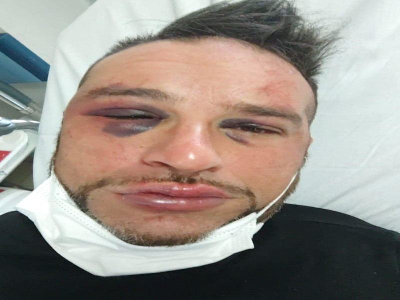 Sassari, l’artista Luca Tilocca pestato a sangue: “Preso a calci e pugni per mezz’ora da due giovani”