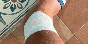 Carloforte, i pesci mordono un’ulcera sulla gamba: bagnante rischia l’emorragia