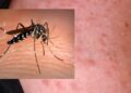 West Nile, aumentano i casi in Sardegna e sale la preoccupazione nel Medio Campidano dopo un decesso e un contagio a San Gavino